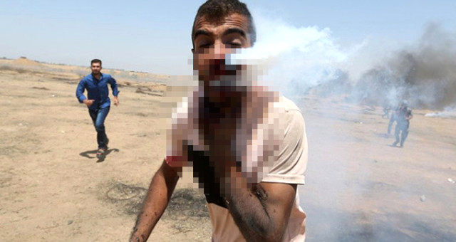 İsrail Askerinin Attığı Gaz Kapsülü Filistinli Gencin Boğazına Saplandı