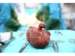 Böbreğinden 12 Santimetre Çapında Taş Çıktı