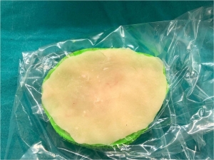 Eskişehir’de İlk Kez Üç Boyutlu Yazıcı Tekniği İle Kranioplasti Ameliyatı