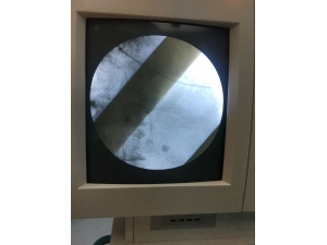 Ardahan‘da İlk Kez Kalp Pili Nakli Yapıldı