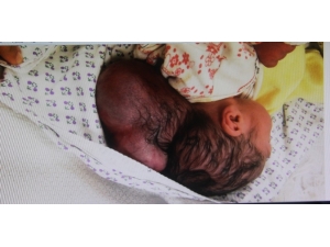 Hatay’da İki Kafalı Bebek Dünyaya Geldi