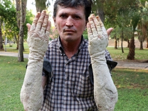 Görenlerin Korkup Kaçtığı Sedef Hastasına Türkiye Duyarsız Kalmadı