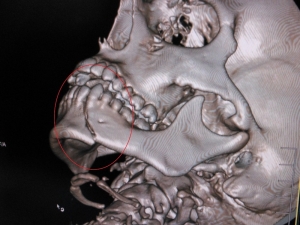 Alt Çene Kemiği Kırıkları