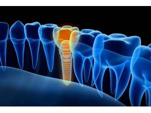 “Başarılı İmplant İçin Kemik Kalitesi Önemli”
