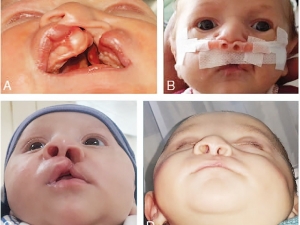 Diş Hekimliği Fakültesinde Yarık Damak Dudak Tedavilerine Başlandı