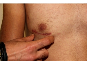 Göğüs Kafesi Açılmadan Delik Kalbi Ameliyat Edildi