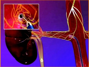 “Renal Denervasyon Tedavisi” Hastalara Umut Oluyor