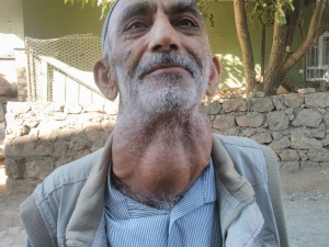 Ameliyattan Korktuğu İçin 30 Yıldır Kitle İle Yaşıyor