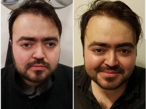 Sevgilisinin Gözlerine Bakabilmek İçin Ameliyat Oldu