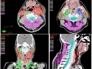 Kanser Tedavisinde ’Yapay Zeka’ Başarısı