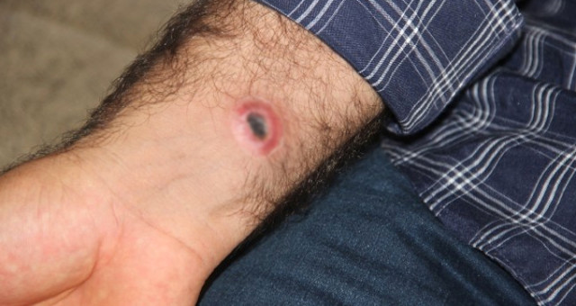 Şarbon Hastalığı Nedir, Nasıl Ve Nerelerden Bulaşır, Belirtileri Nelerdir?