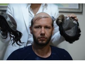 Protez Saçta Merdiven Altı Uygulamalara Dikkat