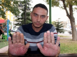 Elleri Sürekli Şişen Genç Yardım Eli Bekliyor