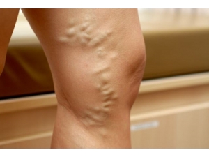 Varisten Kurtulmak Mümkün