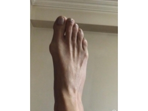 ’Ayak Başparmağı Yanında Kemik Çıkıntısına’ Ameliyat Uyarısı