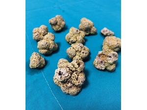 96 Yaşındaki Hastadan İdrar Kesesini Dolduracak Kadar Çok Taş Çıkarttılar