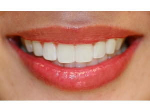 Etkileyici Ve Doğal Gülüşün Sırrı