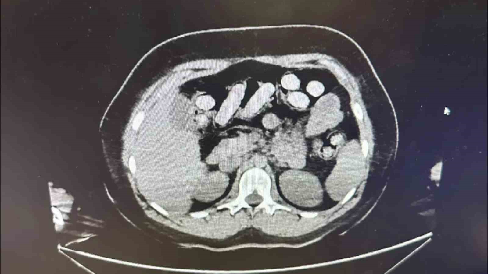 1-5-kilo-metamfetamin-iki-kadin-kuryenin-bagirsak-ve-midesinden-cikti