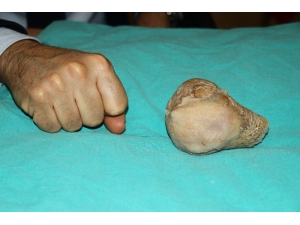 Mesaneden Tek Parça Halinde 10 Santim Ve 270 Gram Taş Çıkardılar