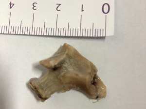 Yemek Borusundan 3 Santimetrelik Kemik Çıkarıldı