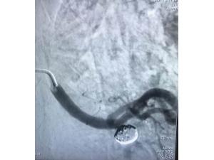 Bu Yöntem İle Ameliyata Gerek Kalmıyor