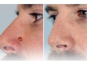 Ameliyatsız Ben Tedavisi