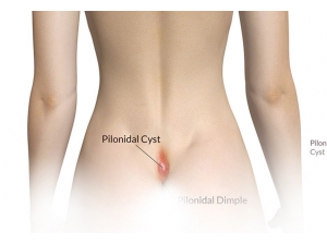 Mikrosinüsektomi Yöntemiyle Kıl Dönmesi Tedavisi