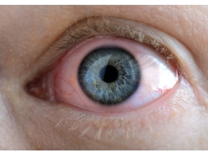 Fazla Sulanan Gözlere Dikkat!