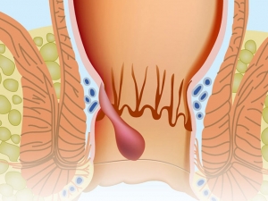 Ameliyatsız Hemoroid Tedavisi