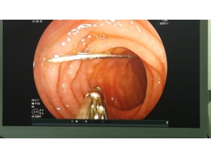 9 Aylık Bebek 4 Santim Boyunda İğne Yuttu