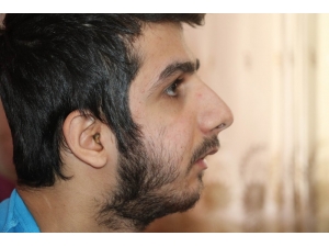 Yanlış Tedavi Yüzünden Çene Gelişimi Durdu