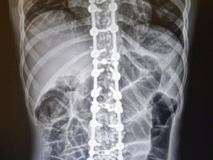 Omurga Eğriliğinden Kurtuldu