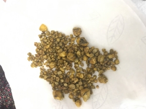 Safra Kesesinden 311 Adet Taş Çıktı