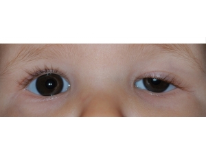 Çocuklarda Göz Kapağı Düşüklüğü Önemsenmeli