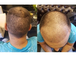 "Yeni Saç Ekimi Yöntemi, Diğer Yöntemlere Göre Daha Kalıcı Daha Hızlı Sonuçlar Alıyor"