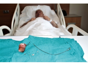 Unutulan 28 Santimlik ’Stent’ 7 Yıl Sonra Fark Edildi