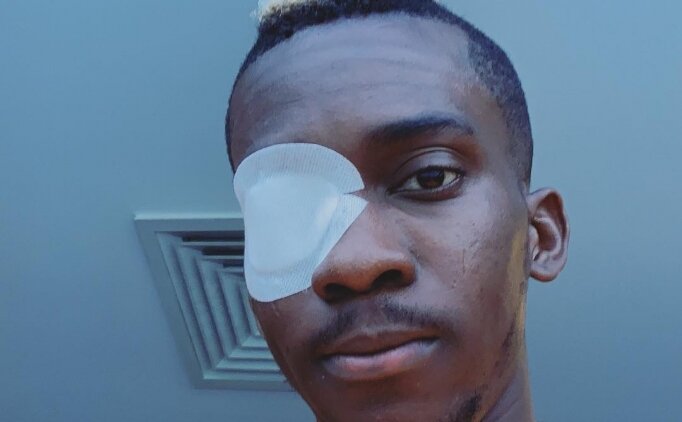 Henry Onyekuru'nun Gözünün Son Hali!