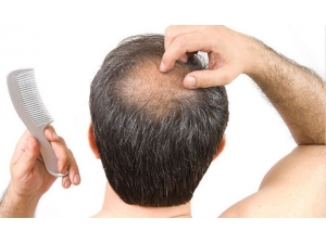 Saç Ekimi Hakkında Merak Edilenler