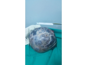 Kabızlık Şikayeti İle Gitti Karnından 30 Santimlik Kist Çıktı