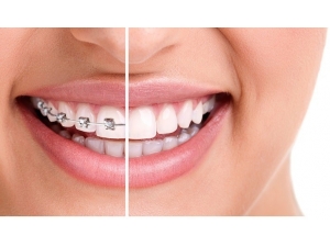 Çarpık Dişlere Telsiz Çözüm