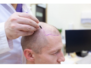 Hastane Ortamı Dışında Yapılan Saç Ekimleri Türkiye’nin Sağlık Turizmini Tehdit Ediyor