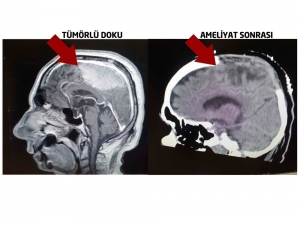 Alman Doktorların Felç Ettiği Hastayı Türk Doktorlar Ayağa Kaldırdı