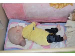 Beyninin Bir Kısmı Dışarıda Olan Bebeğe Devlet Sahip Çıktı