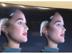 Op. Dr. Volkan Kahya: “Burun Estetiği Öncesi Burnum Nasıl Olacak Diye Üzülmeyin”