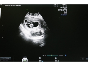 Riskli Gebeliklerin Takibi Kolaylıkla Yapılabilecek