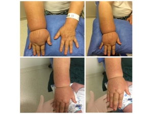 Lenfodem Hastalarına Ameliyatsız Tedavi