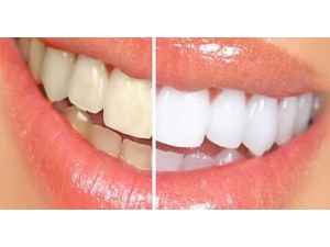 Dişlerde Renk Değişimine Dikkat