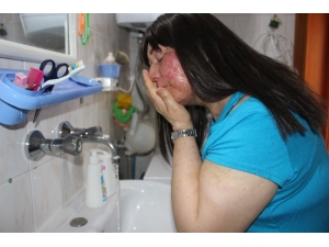 Yıllara Sonra Suyla Barıştı, Güneşle Barışamadı