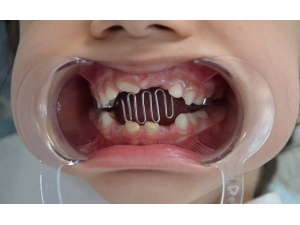 Parmak Emme Alışkanlığı Rahatsızlıklara Davetiye Çıkartıyor