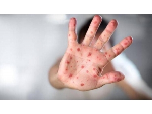 Çocuklarda El-ayak-ağız Hastalığı Hastalığına Dikkat